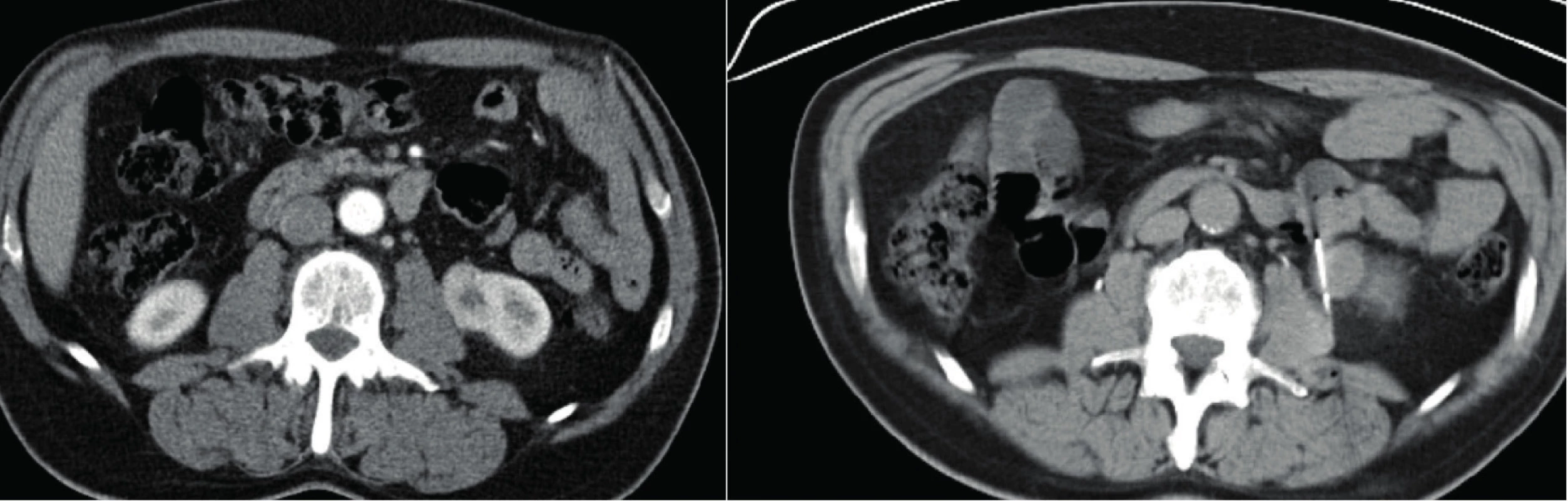 CT, transverzální řez. Muž, 50 let. Vlevo CT snímek před biopsií s popisem tumoru levé ledviny, suspektní
onkocytom. Vpravo snímek během biopsie. Histologicky potvrzený onkocytom<br>
Fig. 4. CT scan, transverse plane. A fifty year old male. In the left picture – CT scan prior to the biopsy with the
description of the tumor of the left kidney, oncocytoma suspected. In the right picture – CT scan during the biopsy.
Histologically confirmed oncocytoma