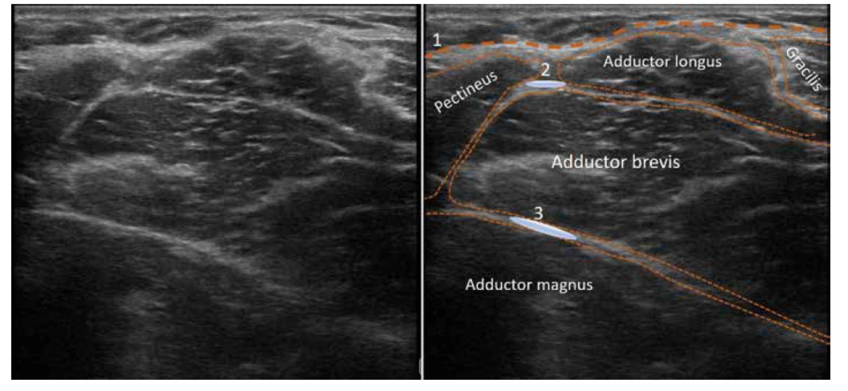 Ultrazvukový obraz proximální mediální části stehna. 1. fascia lata, 2. aplikační oblast pro blokádu n. obturatorius anterior, 3. aplikační oblast
pro blokádu n. obturatorius posterior