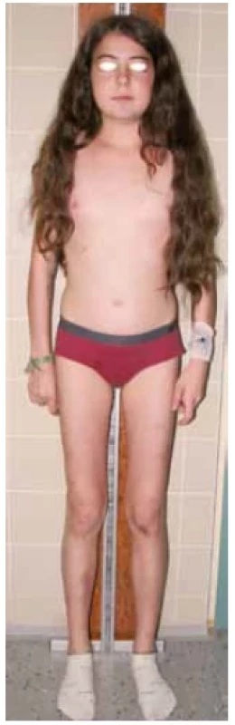 13letá pacientka
v iniciální fázi onemocnění
s neúplným obrazem
Cushingova syndromu.
Dominoval měsícovitý
obličej, zvýšená tvorba
hematomů, opožděná
puberta a porucha růstu.
(foto archiv autorů)