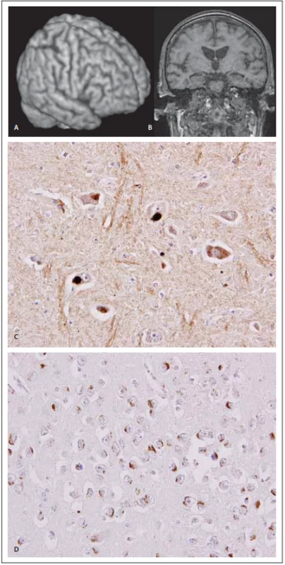 MR a neuropatologie 
u frontotemporální demence 
s amyotrofi ckou laterální sklerózou.<br>
Fig. 3. MRI and neuropathology in frontotemporal dementia and a myotrophic lateral sclerosis.
