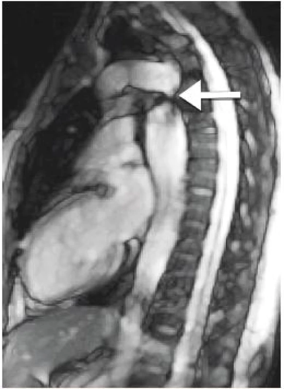 Koarktace aorty (označeno šipkou) při vyšetření magnetickou
rezonancí (archiv autorů).<br>
Fig. 2. Magnetic resonance imaging in native coarctation of
the aorta (authors archive).