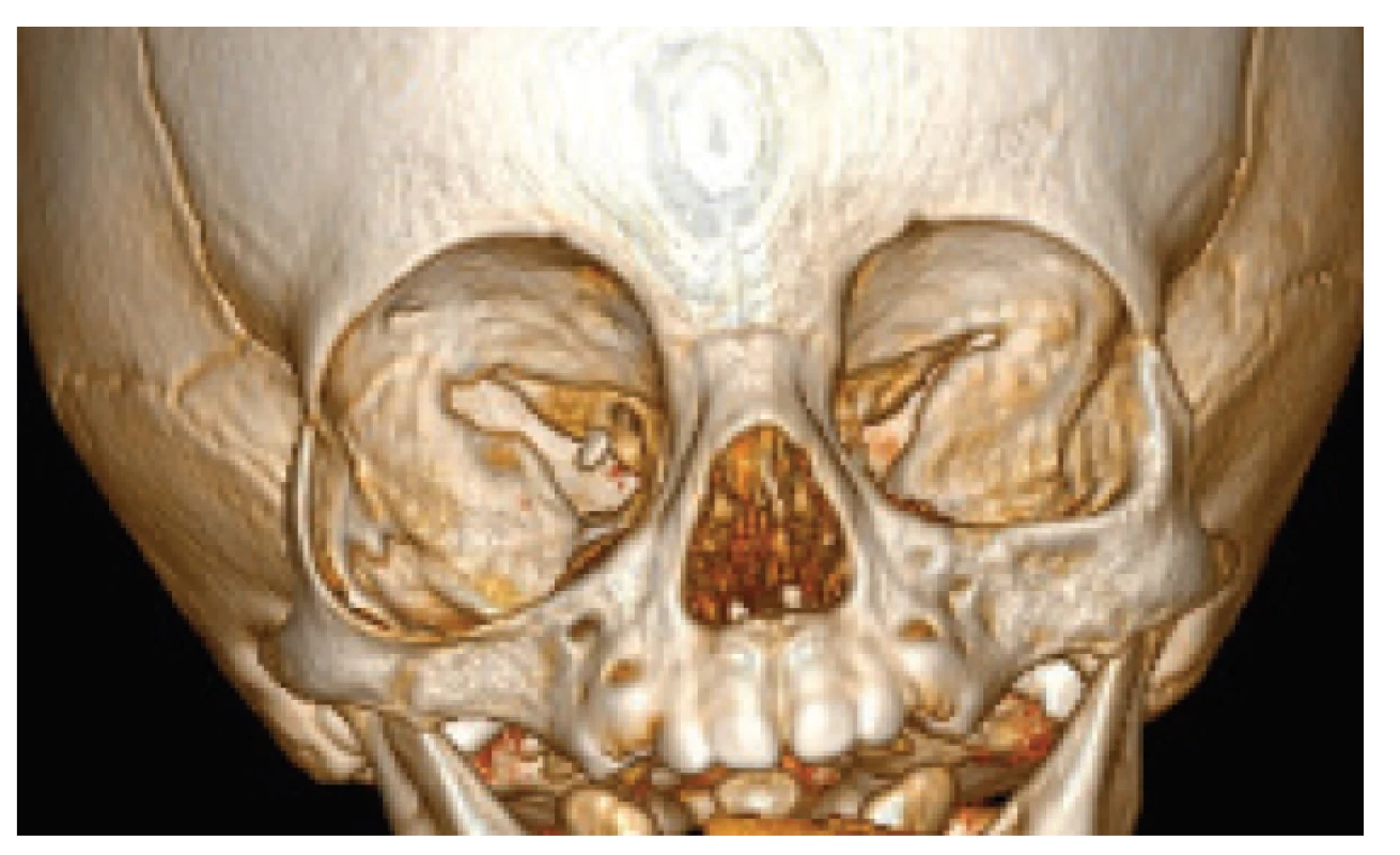 CT examination at the age of 9 months with 3D reconstruction
of facial skeleton, with evident enlargement
of the right orbit