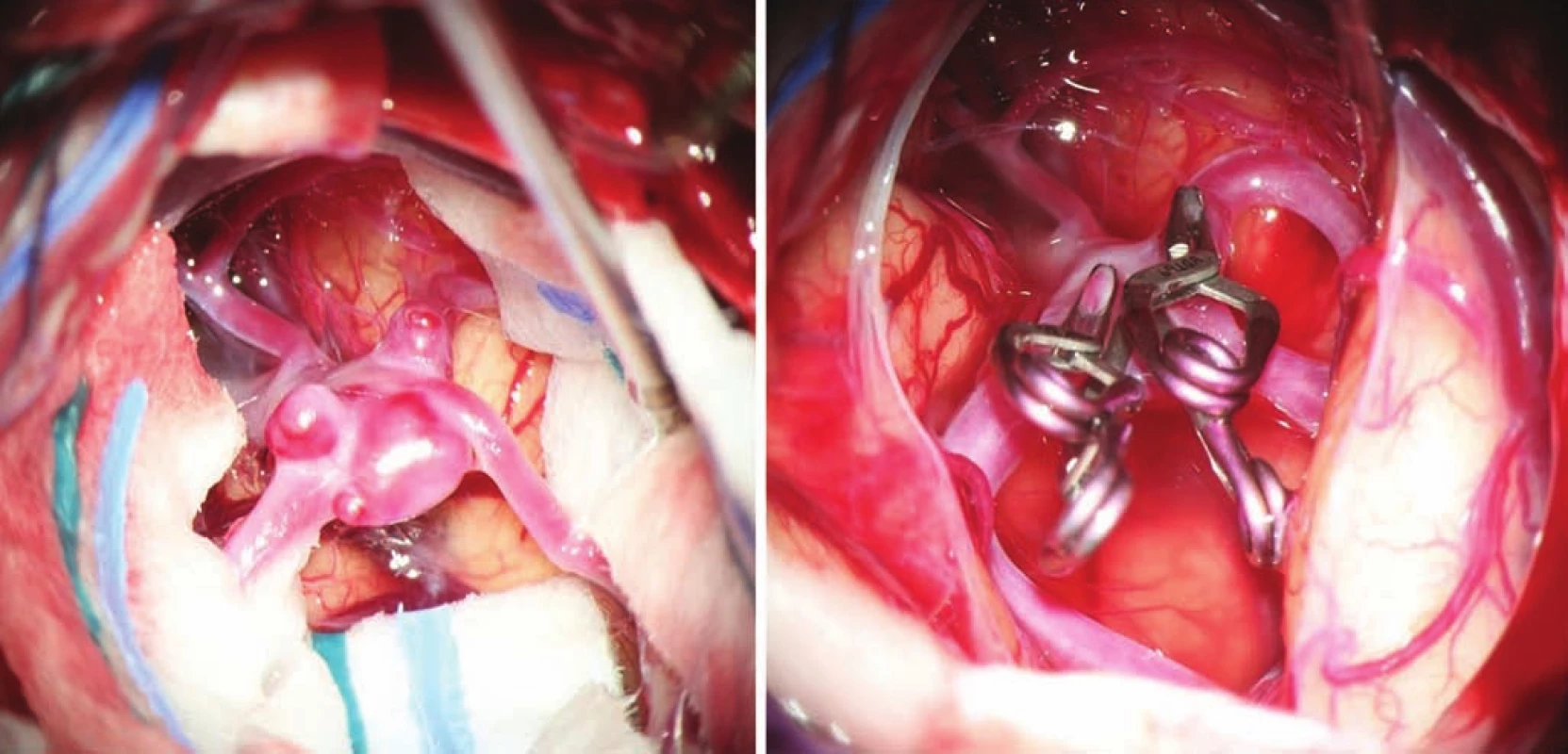 Complex multilobar middle cerebral artery aneurysm before and after clipping.