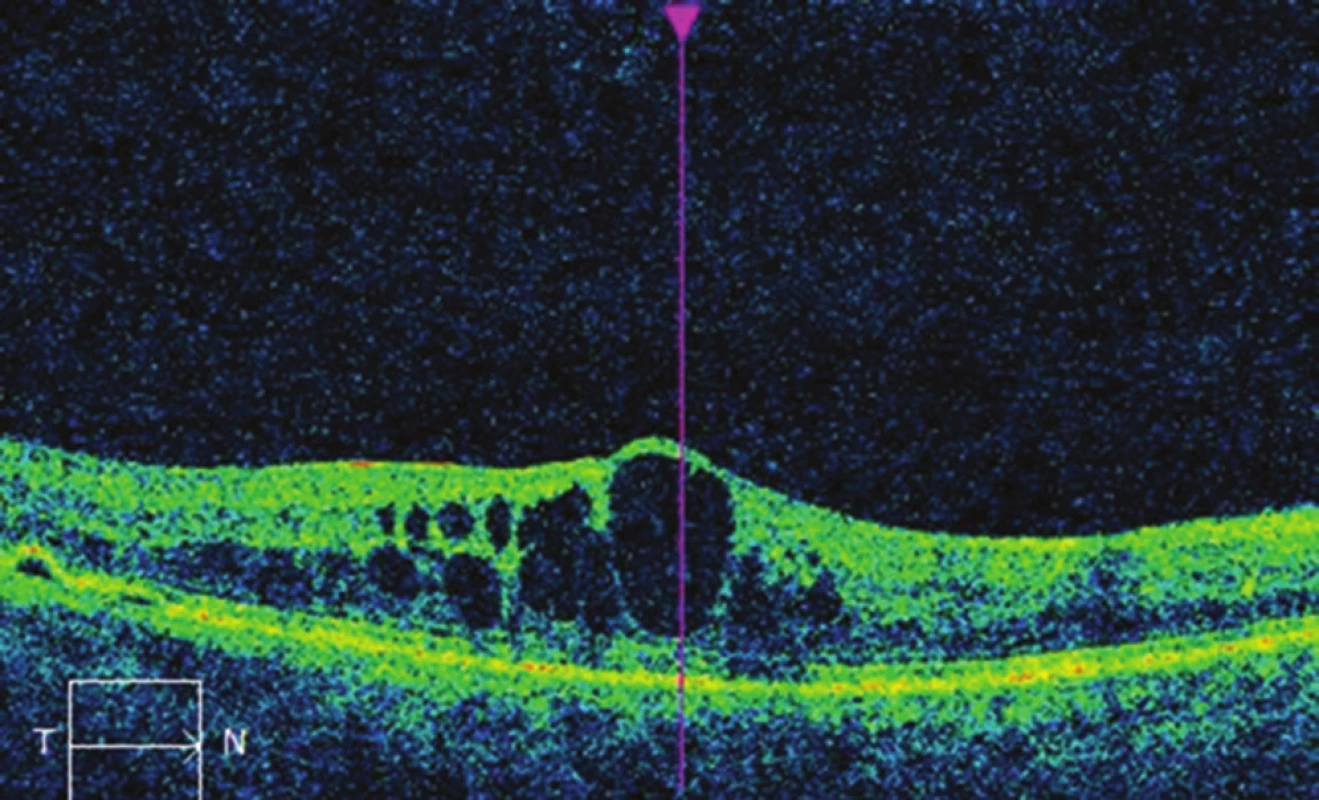 Nález na OCT na pravém oku před léčbou mikropulzním
laserem: cystoidní makulární edém, CRT 495 μm.