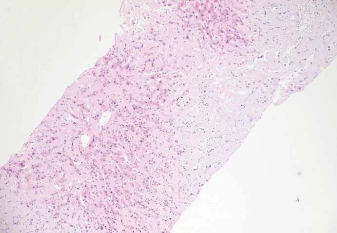 Amyloidóza jater (růžová hmota) a zbytky trámců jaterních buněk.
Fig. 1. Liver amyloidosis (pink substance) and remnants of liver cell plates.