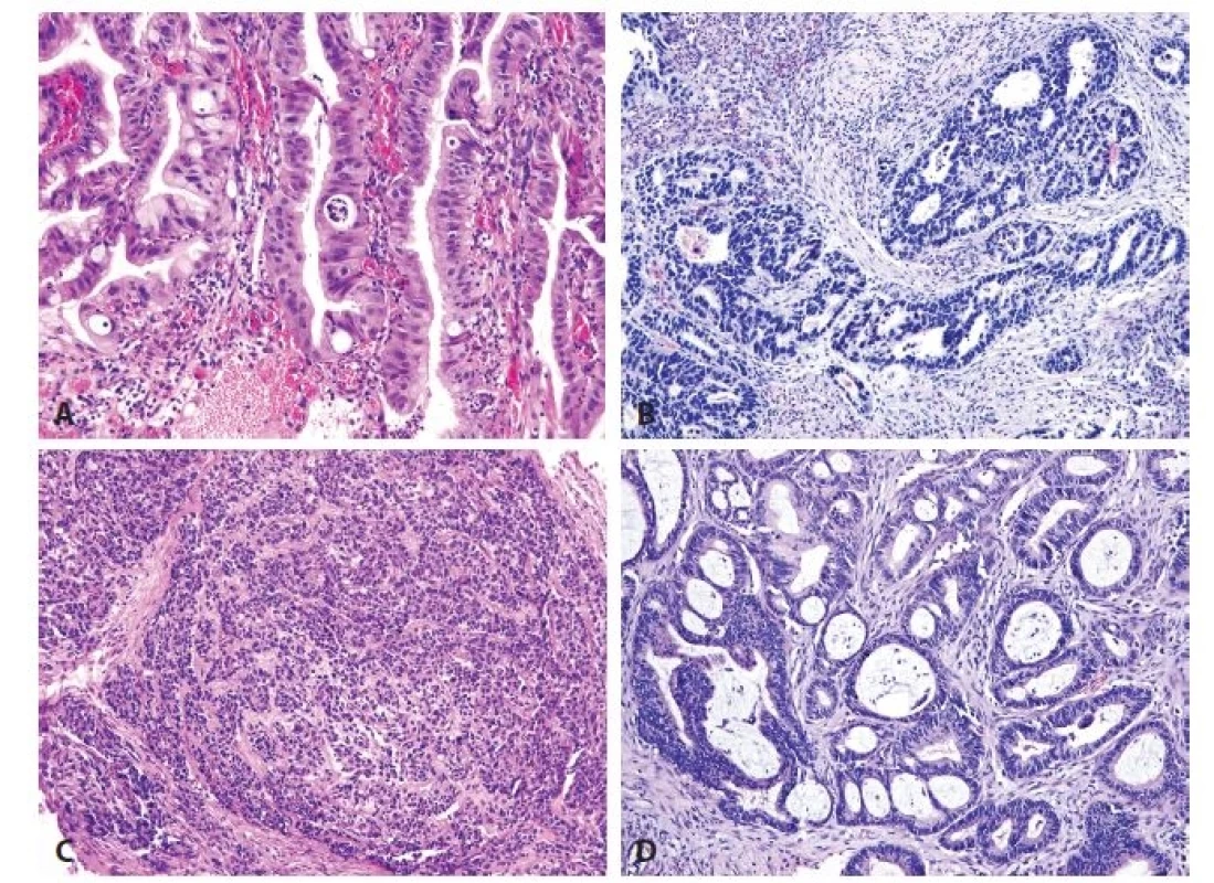 A. High-grade dysplasia. B. Esophageal adenocarcinoma of intestinal type. C. Esophageal adenocarcinoma of foveolar gastric
type, with formation of solid nests. D. Esophageal adenocarcinoma of hybrid type (HE, original magnifications 200x in A, 100x
in B-D, respectively).