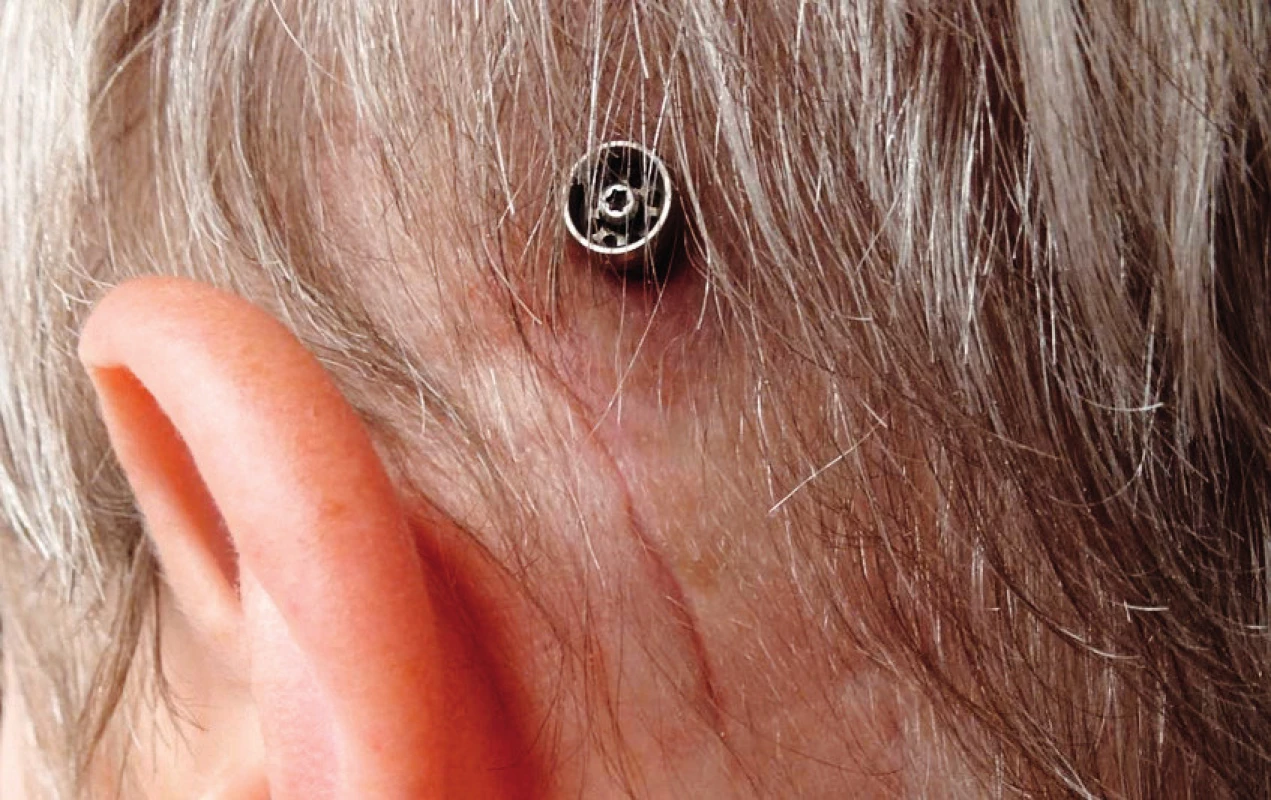 Pacientka se zhojeným implantátem Baha Connect®.
V tomto případě jde o nemocnou po operaci vestibulárního
schwannomu vlevo s následnou hluchotou na tomto uchu. Baha
slouží k vnímání zvuků na hluché straně přenosem vibrací kostmi
lebky do protilehlého hlemýždě. Spodní jizva je po retrosigmoidní
kraniotomii.
(Zdroj: archív MUDr. J. Boučka z Kliniky otorinolaryngologie a chirurgie
hlavy a krku 1. LF UK FN v Motole v Praze.)