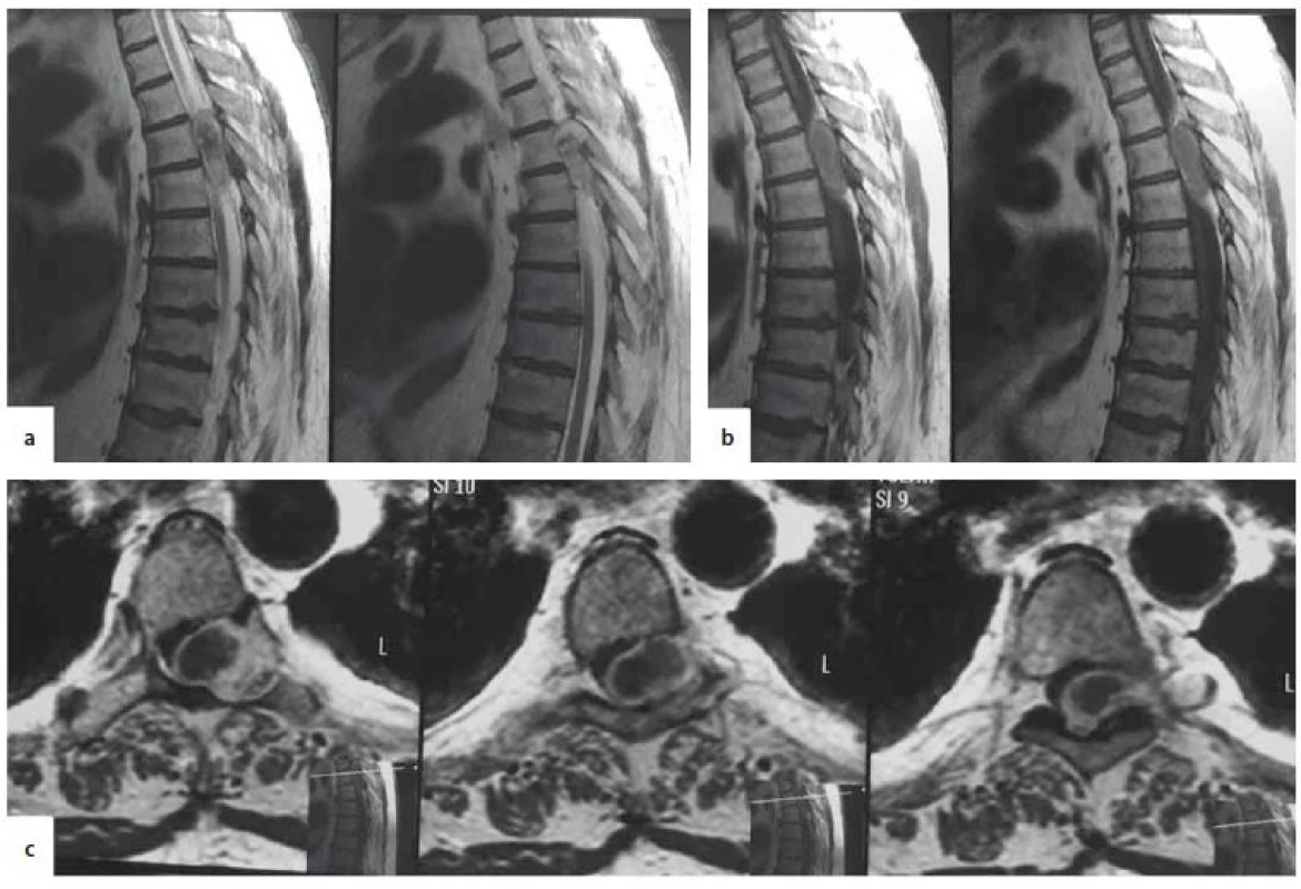 Spinal MRI. A – sagittal T2W, B – sagittal T1W, C – axial T1W. Extramedullary, inhomogeneous, thoracic lesion,
occupying the spinal canal, compressing the spinal cord and extending extraforaminally, enlarging the left
T5–6 foramen.<br>
T1W – T1-weighted image; T2W – T2-weighted image