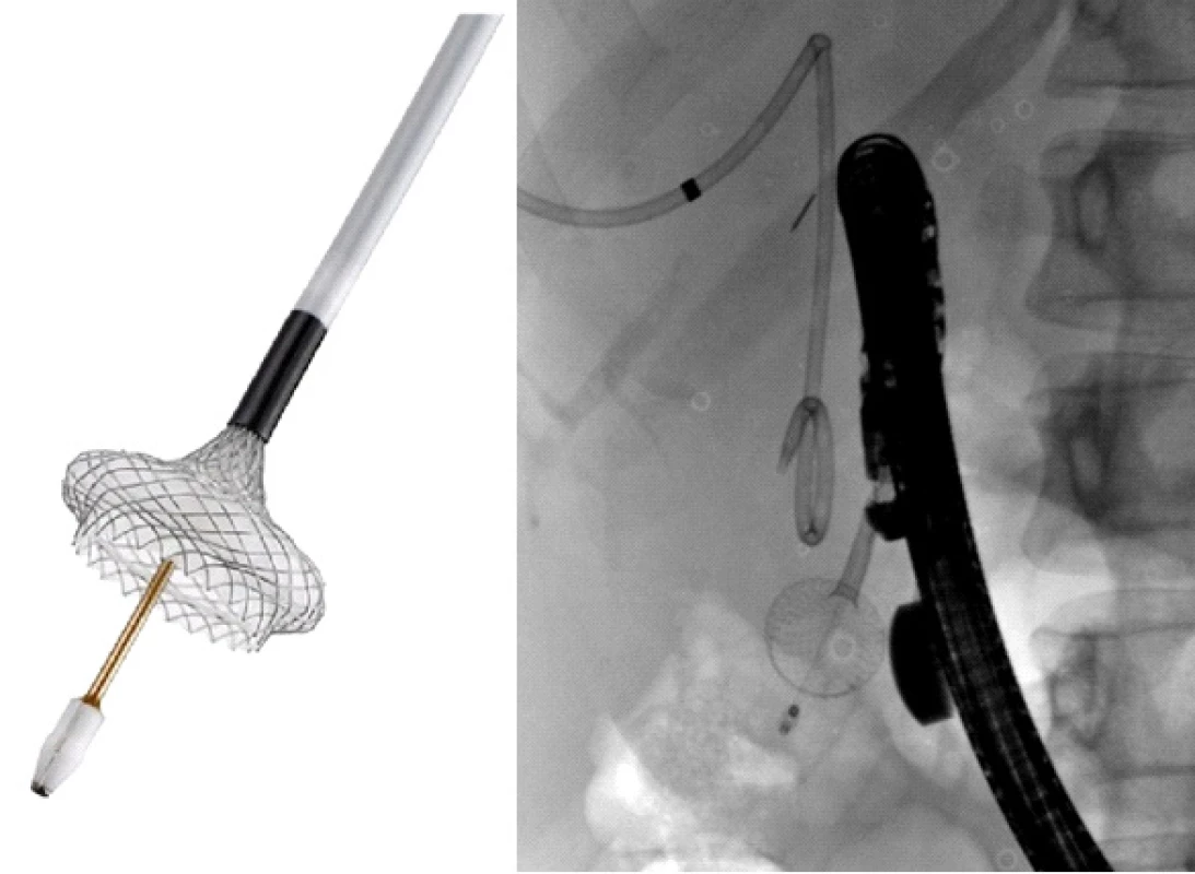 Rozvinutý distální flange (vlevo na schématu,
vpravo na RDG snímku naší pacientky)<br>
Fig. 3: Unfolded distal flange (left in the diagram; right in
the radiology scan of our patient)