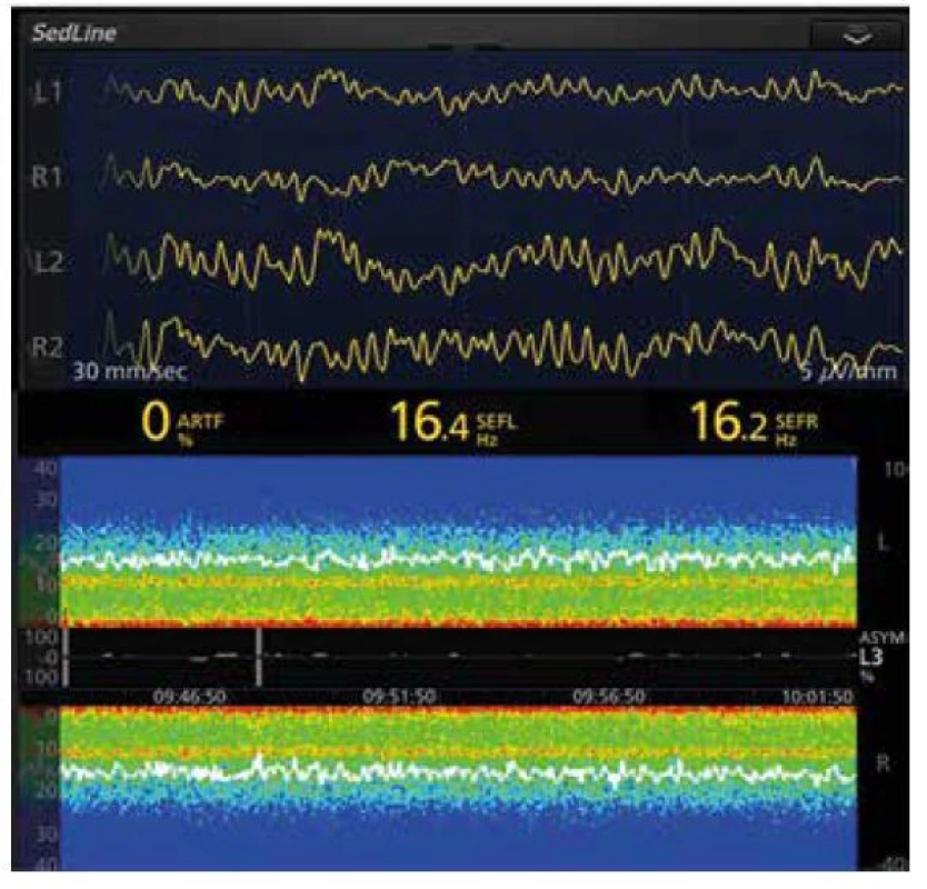 EEG křivka a spektrogram anestezie propofolem 69letého pacienta.
EEG křivka při PSI 40 (není na obrázku), na spektrogramu jsou patrné výrazné
oscilace v pásmech SW-δ (< 4 Hz) a α (8-12 Hz), SEF95 kolísá velmi málo, což
svědčí o dostatečné antinocicepci