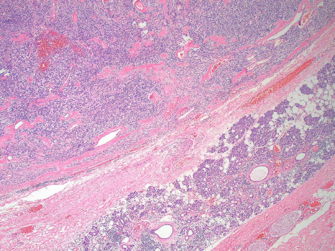 Okapsulovaný tumor v parenchýme seróznej slinnej
žľazy, ktorý bol zachytený na periférii vzoriek (vpravo dolu) (farbenie
hematoxylín a eozín, zväčšenie 40x).