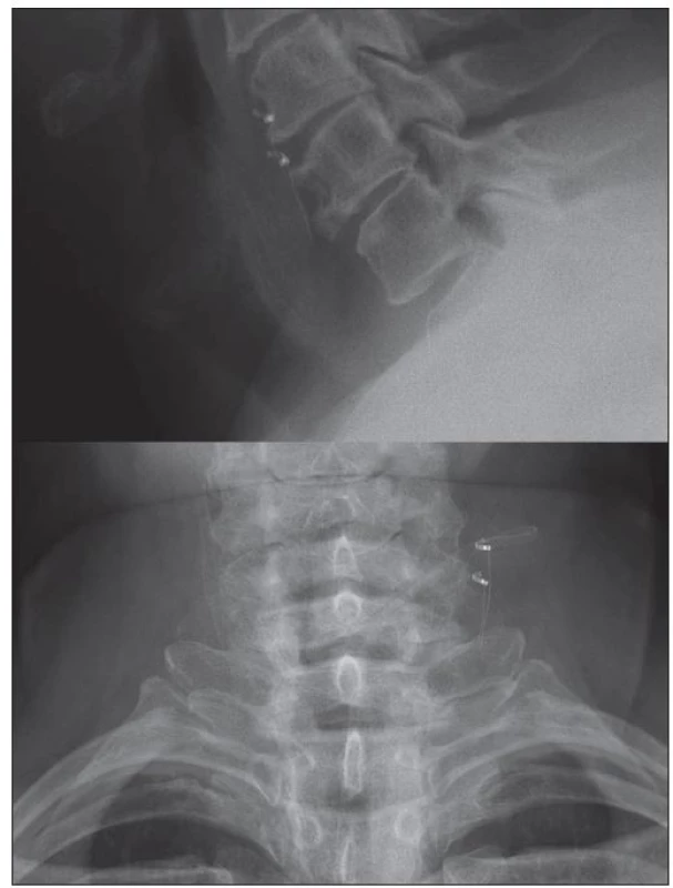 Pooperační RTG s ponechaným zbytkem elektrody na vagovém nervu.<br>
Fig. 4. Postoperative X-ray with the remainder of the electrode on the vagal nerve.