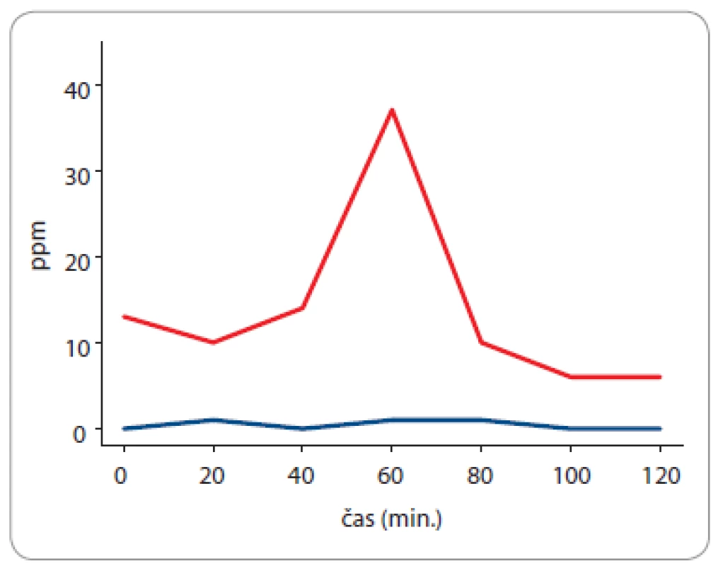 Vodíkový a metanový dechový test u 60leté pacientky,
od roku 2020 léčené pro adenokarcinom pankreatu. Současně
byla diagnostikována exokrinní pankreatická insuficience –
elastáza 1 ve stolici: 104 μg E1 / g stolice (norma > 200 μg E1 /
g stolice). Vzestup koncentrace vodíku je patologický (za 60 minut
po perorálním podání 75 g glukózy), je diagnostický pro
syndrom bakteriálního přerůstání v tenkém střevě (hydrogenní
fenotyp).
