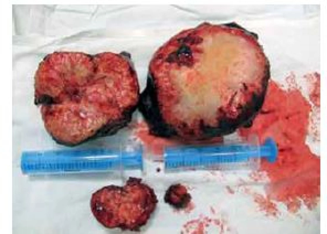Finding during surgical intervention; liver cysts