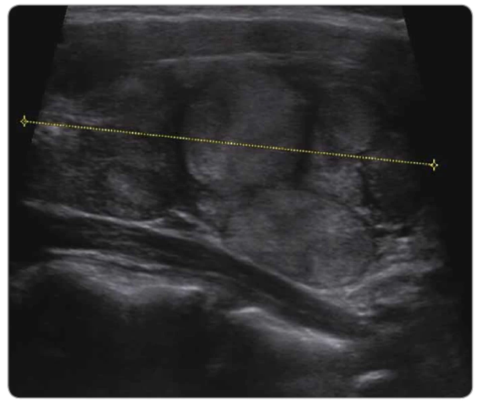 Ultrazvukové vyšetření pacientky z kazuistiky 1 – folikulární karcinom štítné
žlázy, pT1 N0 M0.