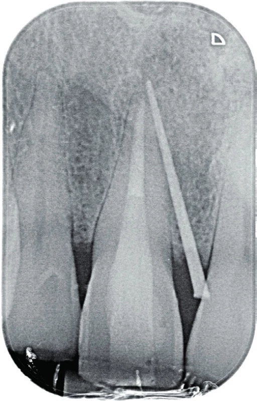 Fistulografie horního
frontálního úseku dva
roky po reendodontickém
ošetření zubu 11. Zavedený
gutaperčový čep ve fistule
směřuje k apexu zubu 11.
Projasnění je na tomto
snímku zřetelné