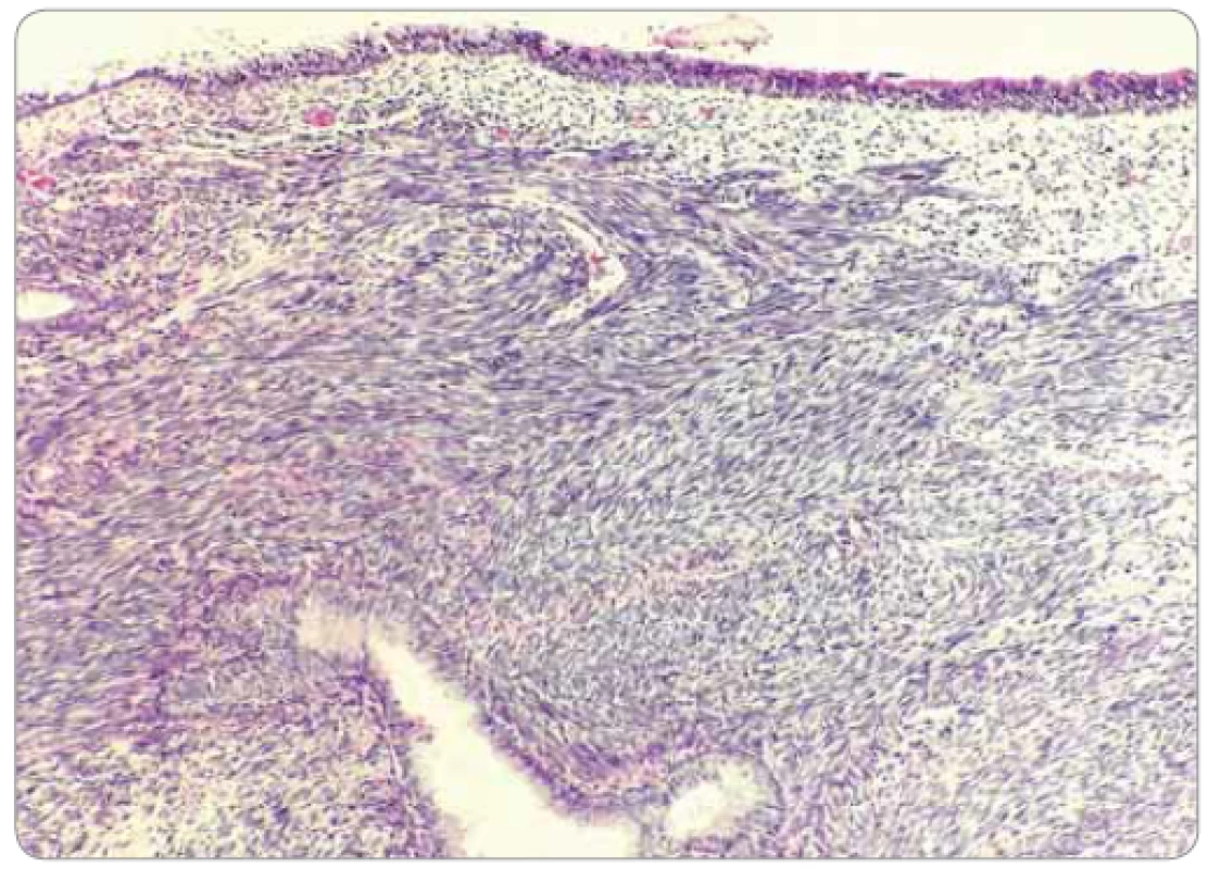 Solídne rastúca vretenobunková nádorová populácia s entrapovaným žľazovým
respiračným epitelom (farbenie hematoxylínom-eozínom, zväčšenie 40×).