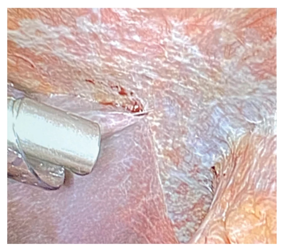Capnopen v dutině břišní<br>
Fig. 6: Capnopen in the abdominal cavity