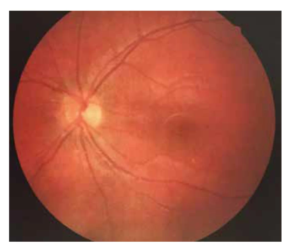 Foto očního pozadí levého oka – fyziologický nález