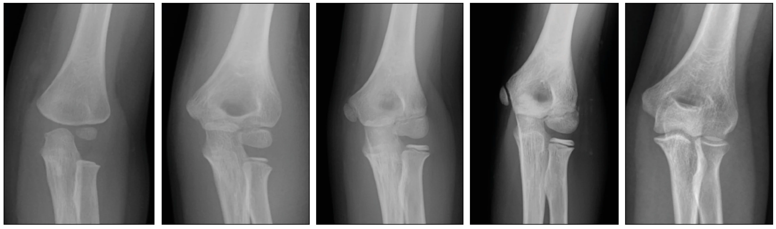 a-e: Gradual development of ossification of the elbow joint. a - 3 years of age, b - 6 years of age, c - 8 years of age, d - 11 years of age, e - 14 years of age