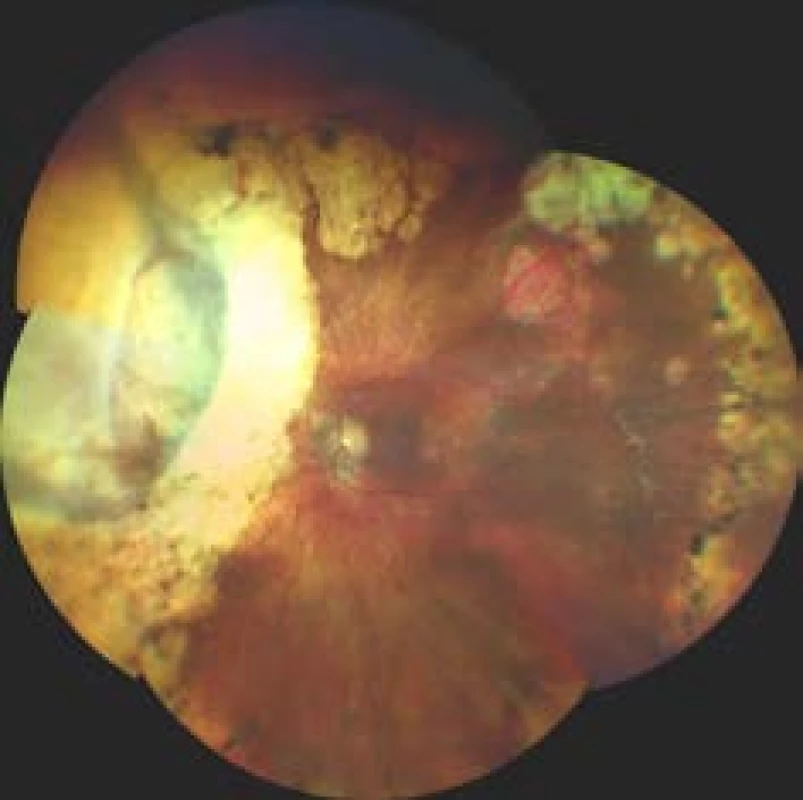 Finding on fundus 10 years after transscleral exoresection of melanoma following prior therapy by LGK