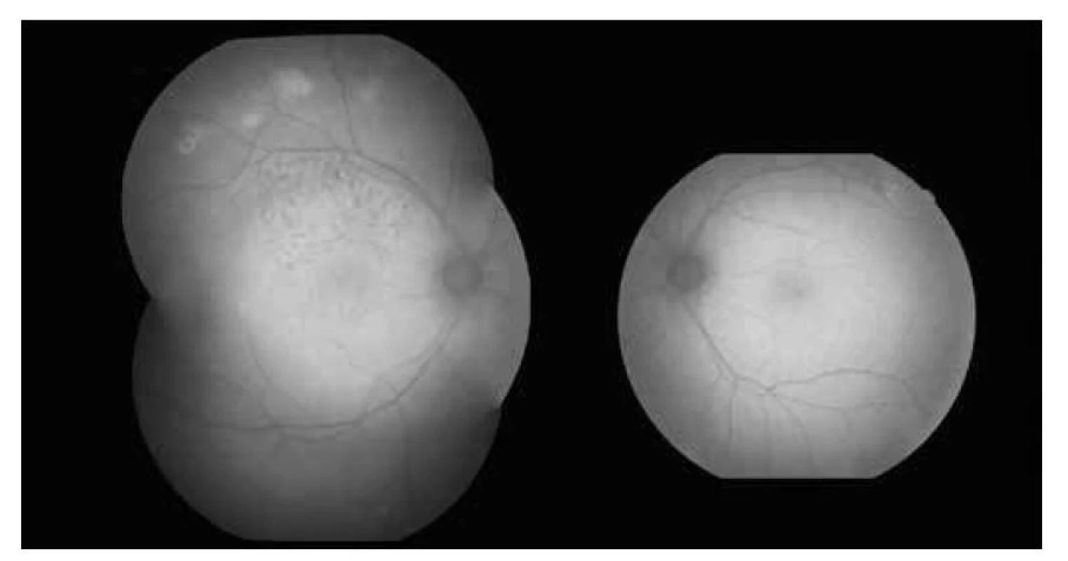 Fundusautofluorecsencia – hyperflourescencie v mieste kalcifikácii a na pravom oku vidno
stopy po fokálnej laserkoagulácii