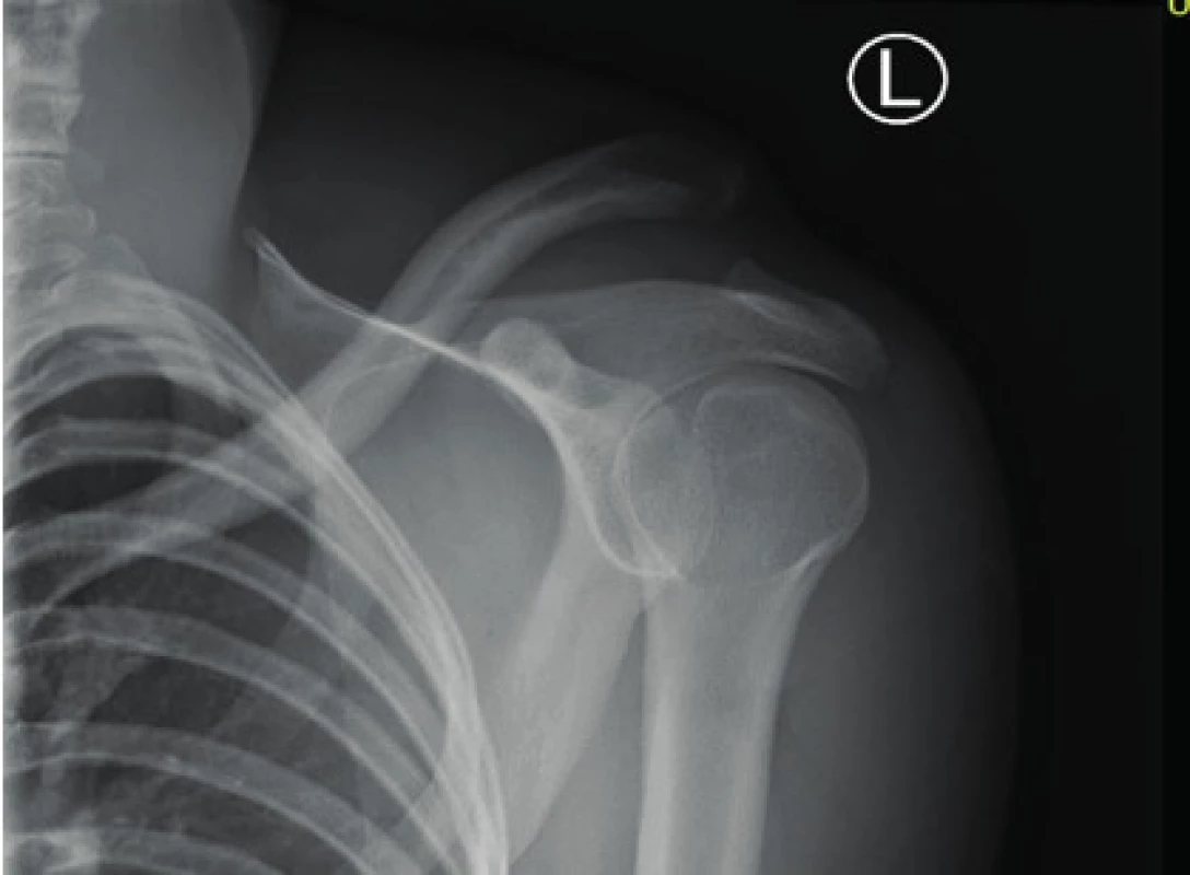 X-ray image of Rockwood type III AC dislocation – trauma