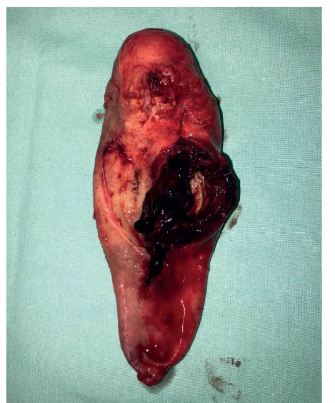 Rozstřižený žlučník s prokrvácenou stěnou s ložiskově
ulpívajícími koaguly<br>
Fig. 3: Cut gallbladder with perfused wall with adherent
coagulae