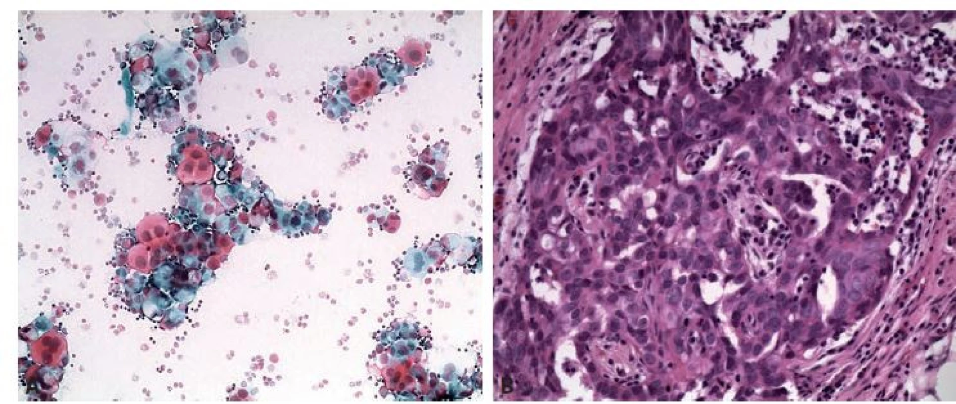 Serózní karcinom high grade. A: Trsy atypických buněk v mírně zánětlivém pozadí. Polychrom 200x. B: Histologicky nález potvrzen.