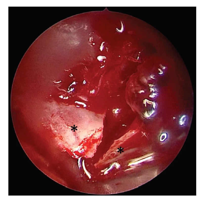 Pohled na dislokované úlomky stropu očnice (hvězdičky),
přístup z endoskopicky asistované přední horní orbitotomie,
endoskopický pohled