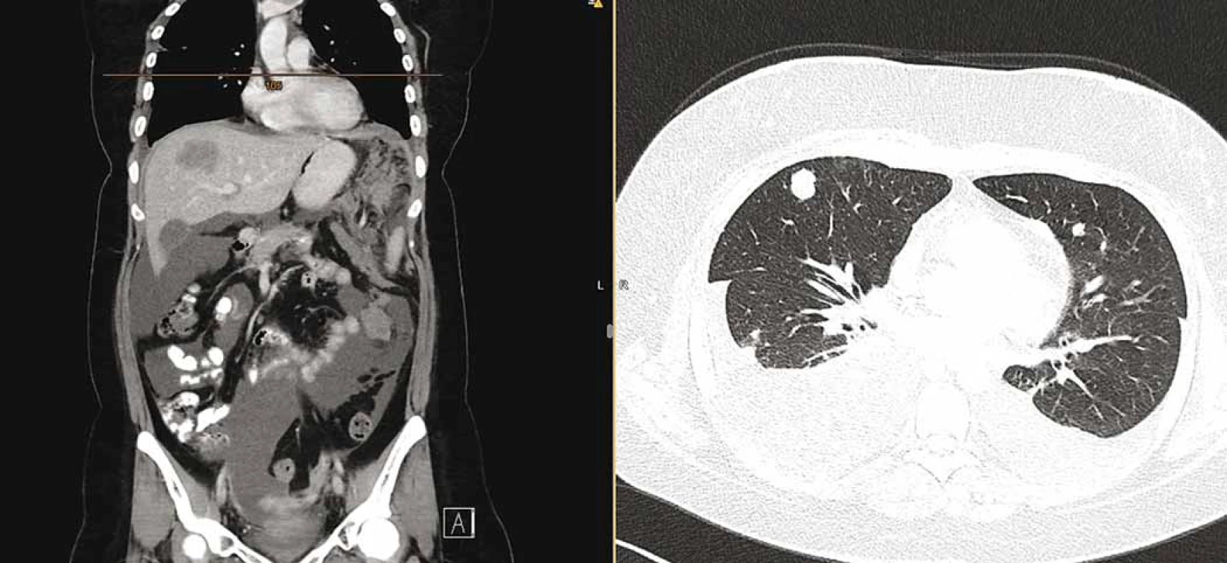 Snímek výpočetní tomografie trupu s potvrzenou parciální regresí nádoru v pánvi, nicméně masivní systémovou progresí
onemocnění se zvětšenými uzlinami na krku a v mediastinu, mnohočetným ložiskovým postižením plic a pleury s oboustranným
fluidothoraxem, vícečetným ložiskovým postižením jater (největší 52 × 36 mm), postižením omenta s měkkotkáňovými masami
(největší 72 × 56 mm) a ascitem.