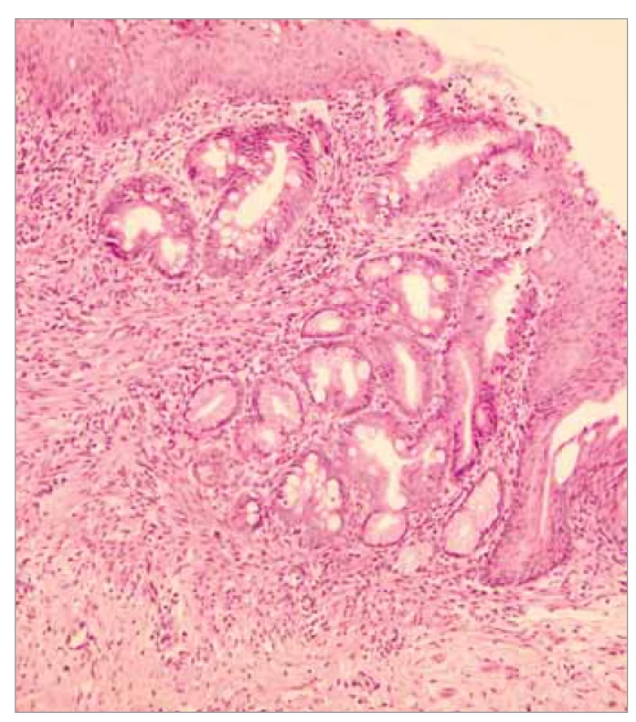Histopatologický obraz gastrického choristomu 2.
Barvení hematoxylin-eozin, zvětšení 20x. Na preparátu
jsou detailněji zachycena místa přechodu žaludečního
epitelu v intestinální metaplazii, jež je známým prekurzorem
adenokarcinomu.<br>
Fig. 5. Histopathological picture of gastric choristoma 2. Hematoxylin-
eosin staining, magnification 20x. The preparation
shows in more detail the sites of gastric epithelial transition
in the intestinal metaplasia, which is a known precursor
of adenocarcinoma.