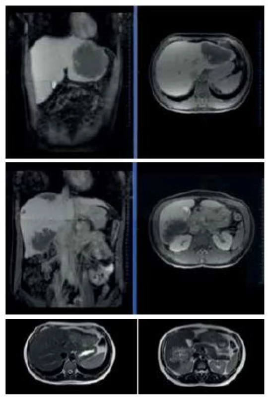 MRI images prior to surgical intervention