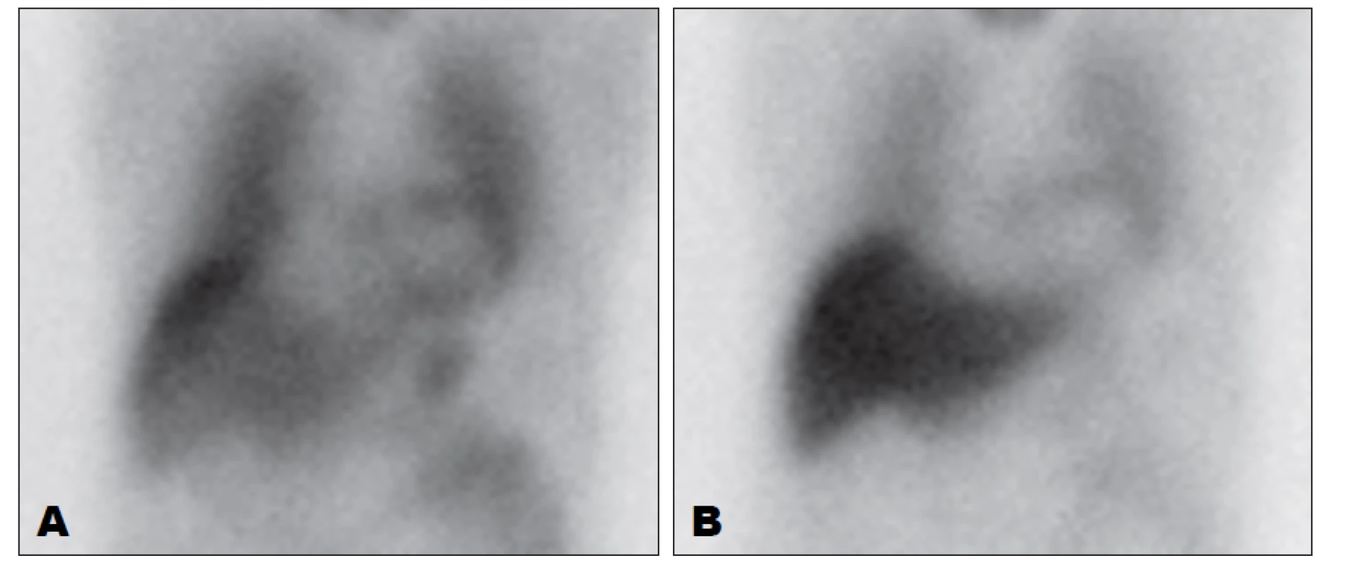 Zobrazení sympatické inervace myokardu pomocí 123I-MIBG, přední planární snímky hrudníku. Vlevo (A) je obraz 15 minut po aplikaci,
vpravo (B) 4 hodiny po aplikaci. Je patrná nízká akumulace MIBG při autonomní neuropatii.