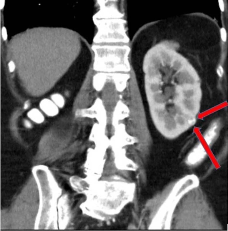 Tumor v oblasti levé ledviny dle
CT zobrazení z druhé poloviny května
2016<br>
Fig. 1. Tumor in the left kidney – CT
May, 2016