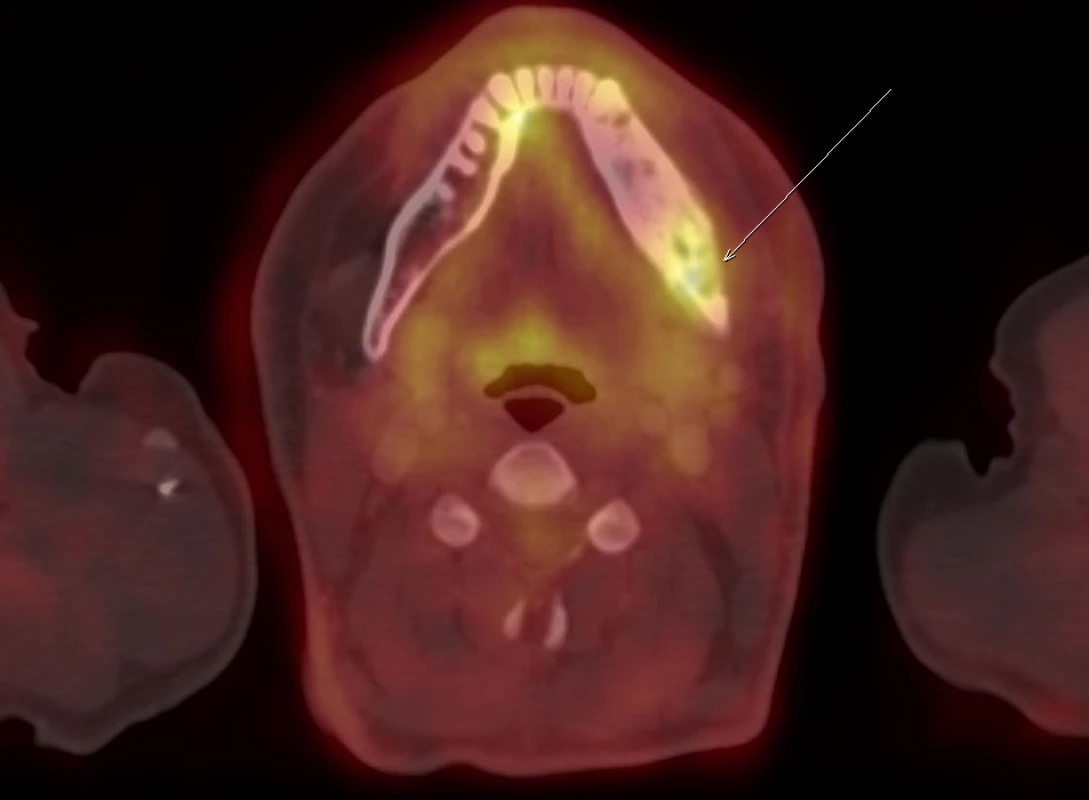 FDG-PET/CT zobrazení dolní čelisti. Patologický proces v dolní čelisti akumuluje FDG (a podobně i jiná radiofarmaka vcelku) ochotně. Dle FDG-PET/CT však
nelze rozlišit fibrózní dysplazii od jiných kostních (nádorových) patologií. V tomto případně bylo prokázáno jen toto jediné izolované kostní ložisko v mandibule