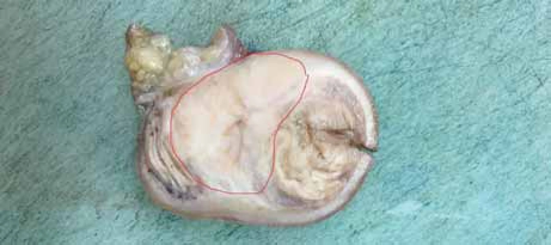 Makrofotografie tenkého střeva s tumorem na řezu, nádorová infiltrace
označena červeně.<br>
Fig. 2. Macrophotography of small bowell with tumor on section, tumor infiltration
marked in red.