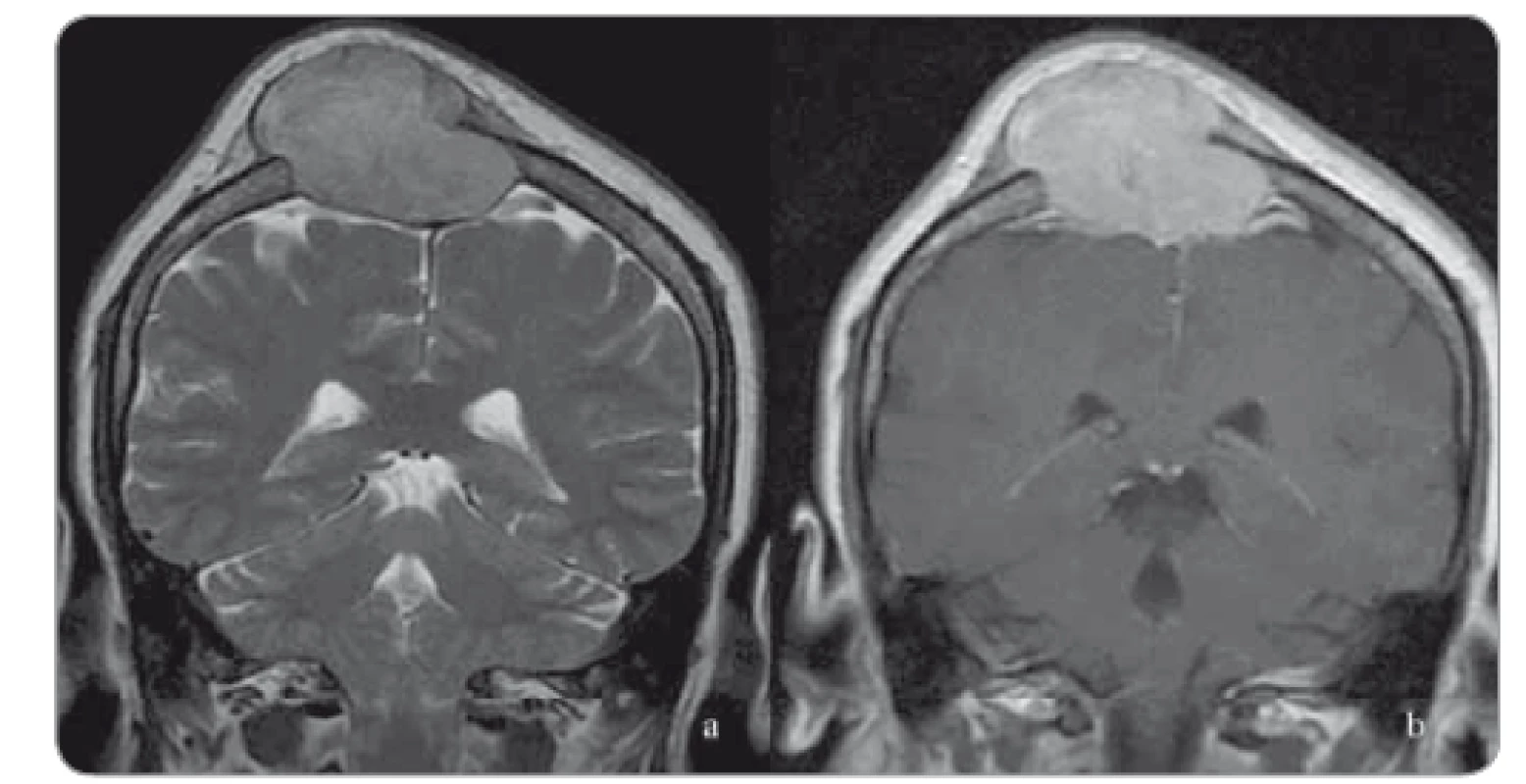 Coronal T2-weighted fast spin echo and sagittal contrast enhanced T1-weighted
MRI images show a calvarial expansile lytic lesion located at the right paramedian
frontoparietal region with an intense heterogenous contrast enhancement. There is
also compression and displacement of superior sagittal sinus without any finding of dural
invasion.