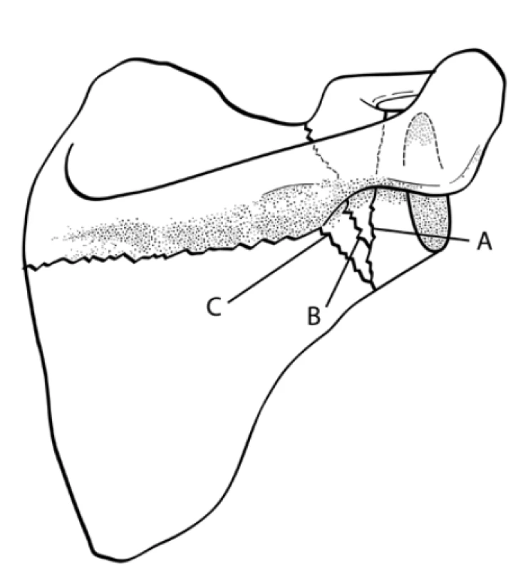 Goss´s classification of scapular neck fractures.
A – fracture of anatomical neck, B – fracture of surgical
neck, C − fracture of neck inferior to scapula spine (Figure
adapted from Goss, Ref. [6]).