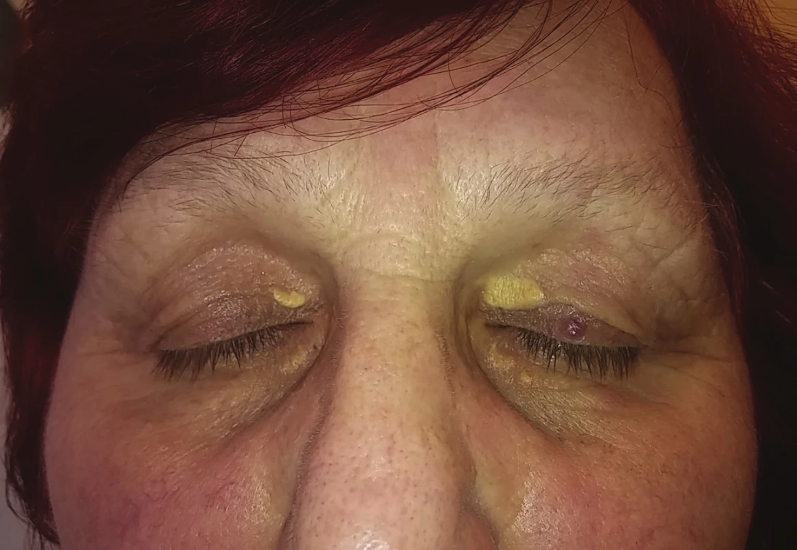 Xanthelasma palpebrarum of the upper and lower eyelid of both eyes (from the archive of the Preventive Cardiology Centre, 3rd Internal Clinic, General University Hospital Prague)