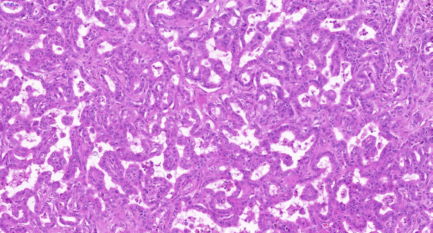 Periferní typ intrahepatálního cholangiocelulárního karcinomu. Na rozdíl od nádoru na obr. 2 je zde patrné rozsáhlé anastomozování, adenokarcinomové žlázky jsou vzájemně propojené. Nádorový epitel je spíše kubický. Množství nádorového stromatu je minimální. Histologický řez z chirurgického resekátu, hematoxylin-eozin, 20×.