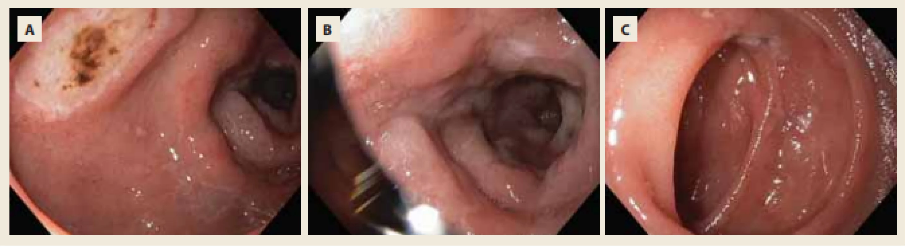 Mnohočetné akutní vředy bulbu a D2 duodena charakteru Forrest IIc a III. <br>
Fig. 3. Multiple acute ulcers of duodenal bulb and D2 duodenum – Forrest IIc and III. 