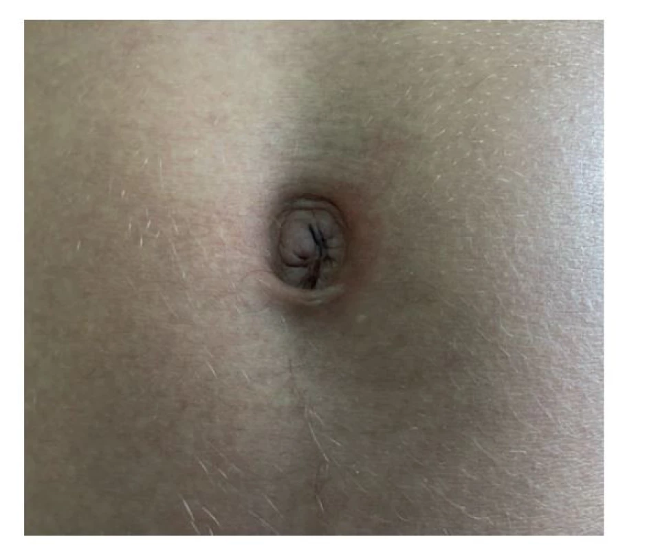 Jizva v pupku za 6 týdnů po operaci<br>
Fig. 7: Scar in the umbilicus 6 weeks after surgery