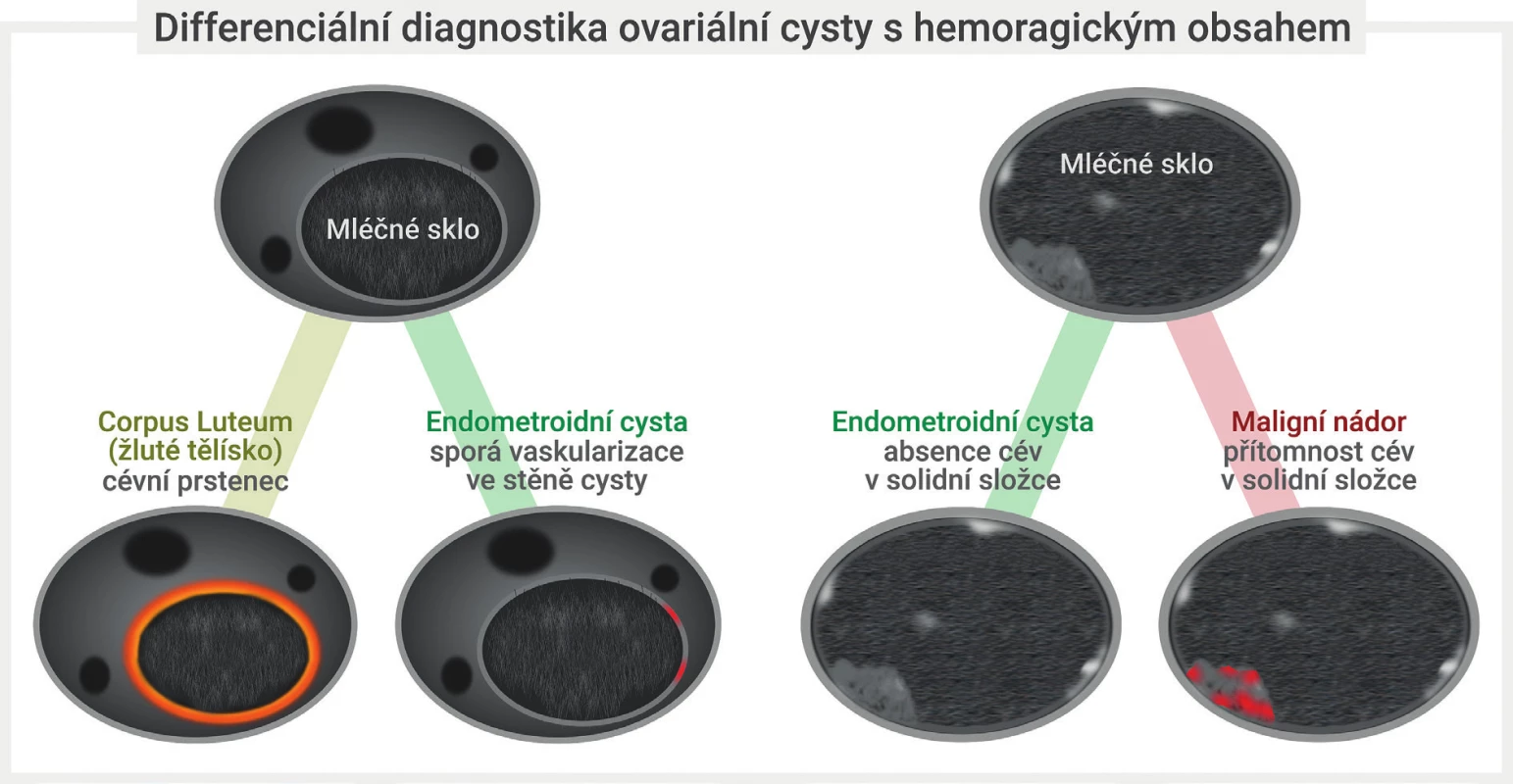 Diferenciální diagnostika hemoragické ovariální cysty<br>
Unilokulární cysta s intracystickou tekutinou vzhledu mléčného skla s cévním hypervaskulárním lemem v zobrazení barevným dopplerem svědčí
pro přítomnost funkční korpusluteinní hemoragické cysty, přítomnost sporé perfuze v pouzdru perzistující unilokulární cysty s tekutinou vzhledu
mléčného skla svědčí nejspíše pro endometroidní cystu. Detekce přítomnosti cév uvnitř intracystické hyperechogenní papilární prominence je
vhodná k odlišení krevního (avaskulárního) koagula od nádorové (vaskularizované) papilární prominence, která je charakteristickým nálezem
ovariálních borderline nádorů. Obrázek modifikován z Guerriero et al [7].