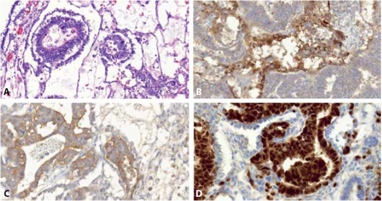 Smíšený germinální tumor sestávající z komponenty embryonálního karcinomu (EK) a yolk sac tumoru (YST). EK je složen ze solidně, pseudoglandulárně či alveolárně uspořádaných anaplastických epiteloidních buněk. YST je tvořen drobnějšími, zploštělými germinálními buňkami uspořádanými mikrocysticky a retikulárně (A). Protilátka glypican 3 barví membranozně a cytoplazmaticky buňky YST, struktury EK jsou negativní (B). CD30 je cytoplazmaticky a membranozně pozitivní v EK, negativní v YST (C). OCT3/4 je nukleárně pozitivní v EK, v YST negativní (D).