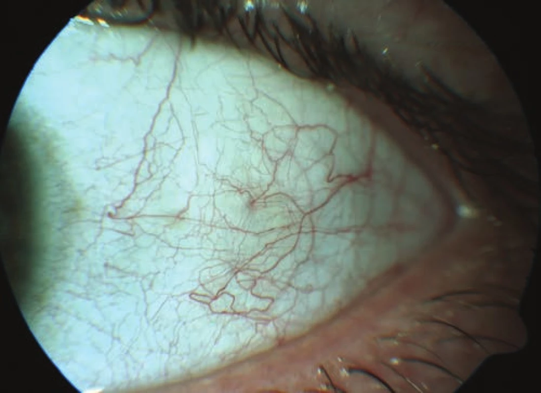 HIV microvasculopathy of the anterior segment of the eye -
vascular tortuosity, intermittent blood flow, microaneurysms