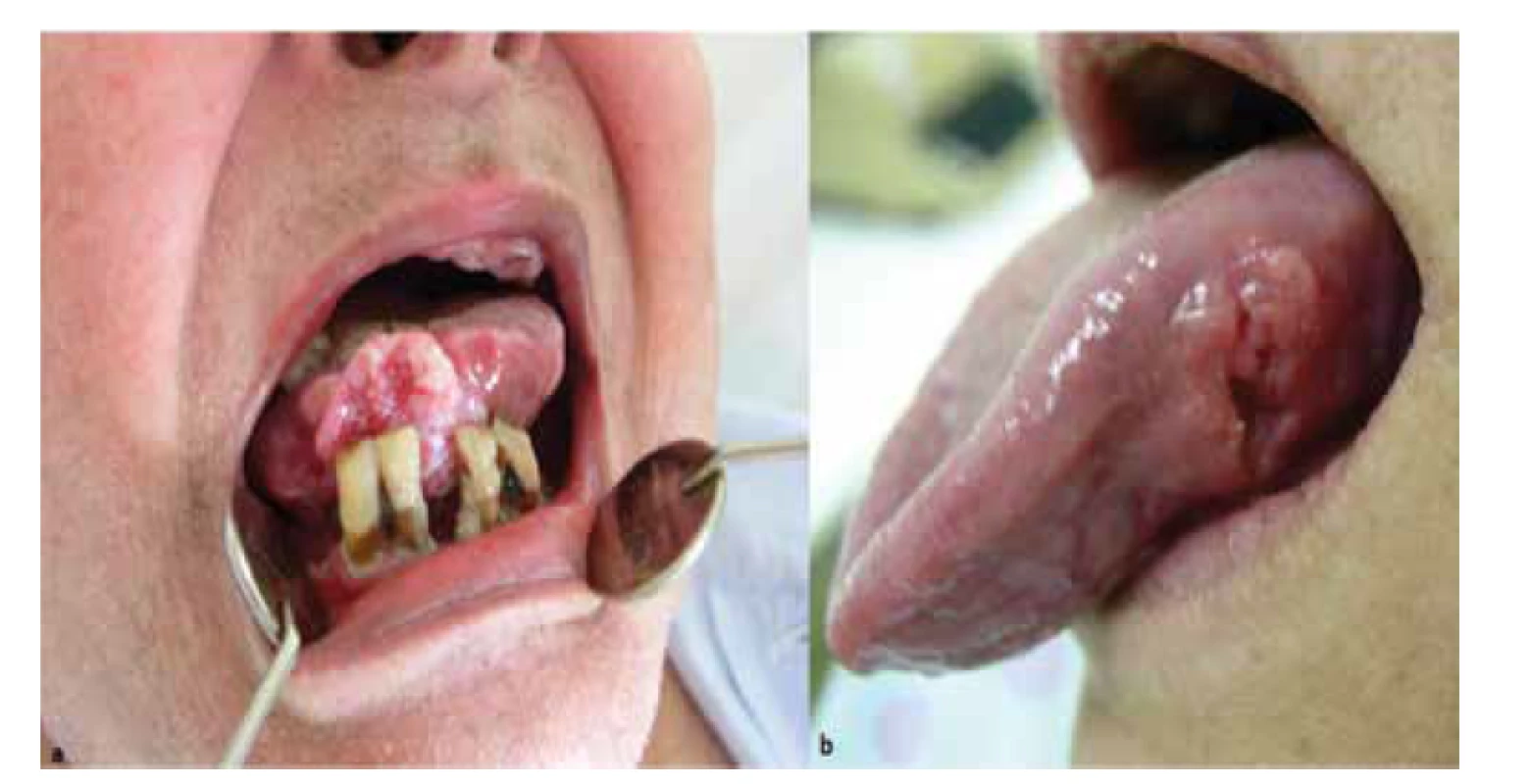 a – pacient s exofyticky rastúcim karcinómom jazyka (jazyk bol palpačně zatuhnutý a mal
obmedzenú hybnosť), b – iná pacientka s karcinómom jazyka, ktorý sa klinicky prejavil ako nehojaca
sa ulcerácia so zatuhnutou spodinou