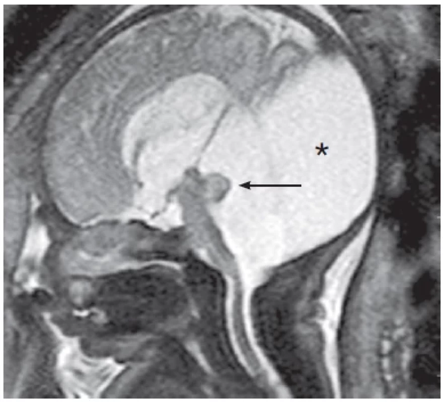 A 30-week-old fetus with Dandy-Walker malformation.
A sagittal T2-weighted Single-Shot Turbo Spin Echo (SSTSE) sequence
at 3-T. MRI shows hypoplastic vermis (arrow) and posterior
fossa cyst (asterisk).