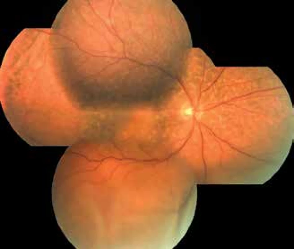 Fotografie očního pozadí pravého oka po operaci
hluboké zadní sklerotomie, duben 2018. Vstřebaná ablace choroidey,
perzistující serózní odchlípení sítnice a leopardí skvrny