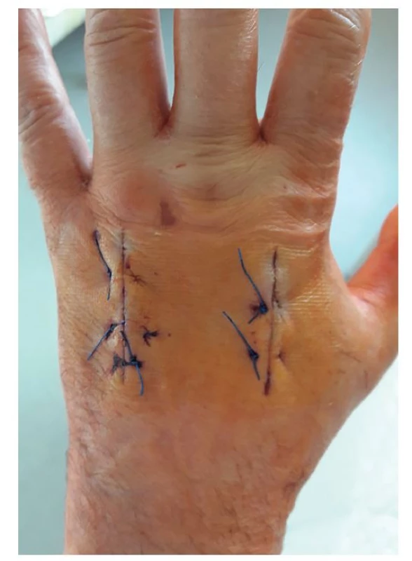 Levá ruka, dorzum, 8. pooperační den<br>
Fig. 8: Left hand, dorsal part, postoperative day 8